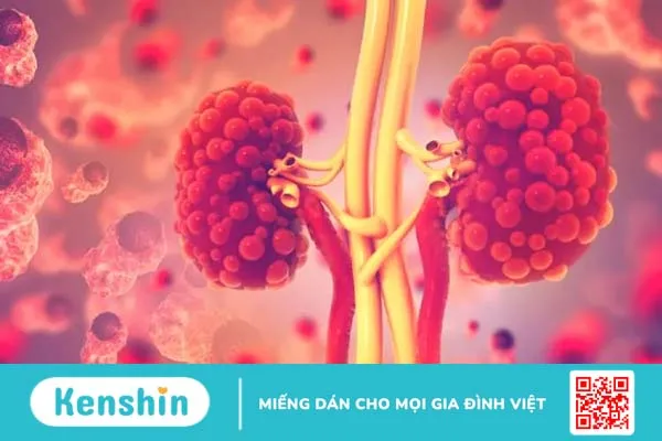 Sỏi bàng quang có nguy hiểm không? Chớ dại mà chủ quan!