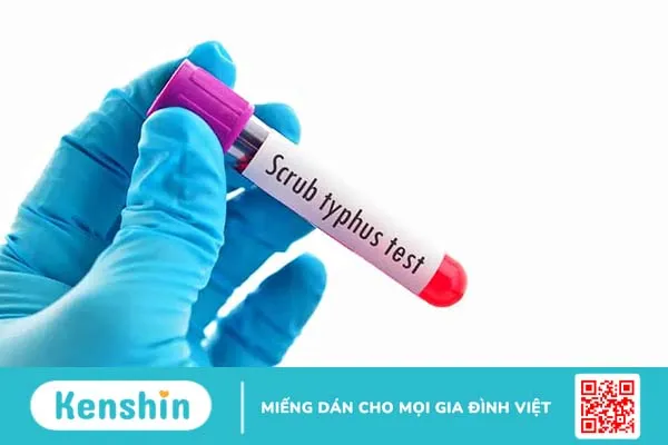 Sốt mò: Bệnh truyền nhiễm cấp tính nguy hiểm và những điều cần biết