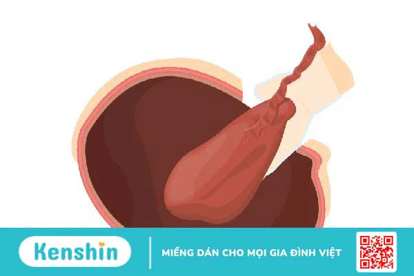 Sót nhau thai sau sinh: Nhận biết triệu chứng, xử lý kịp thời