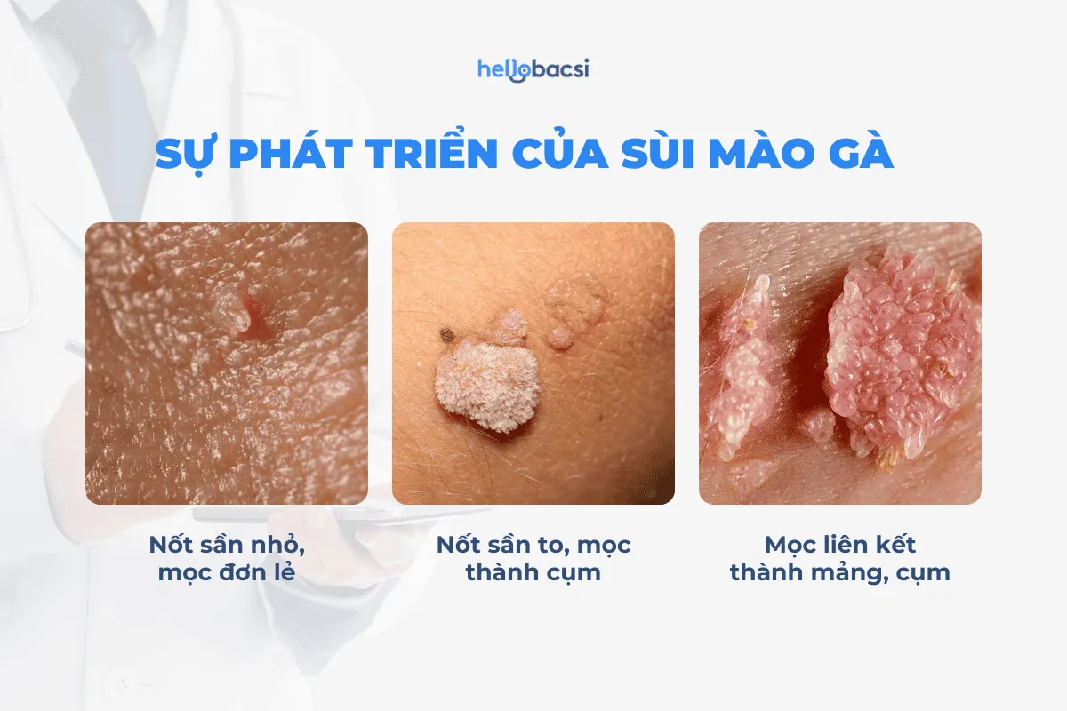 Sùi mào gà hậu môn là bệnh gì? Nguyên nhân, dấu hiệu và cách điều trị