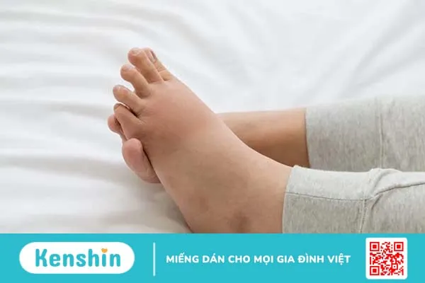 Sưng bàn chân, sưng mắt cá chân: Nguyên nhân do đâu?