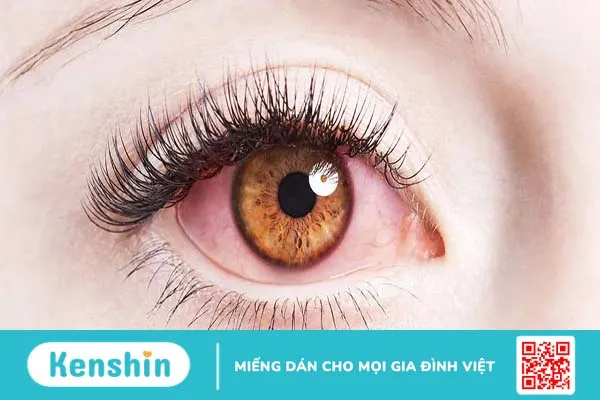 Tác hại của kính áp tròng: Bạn chớ nên xem thường