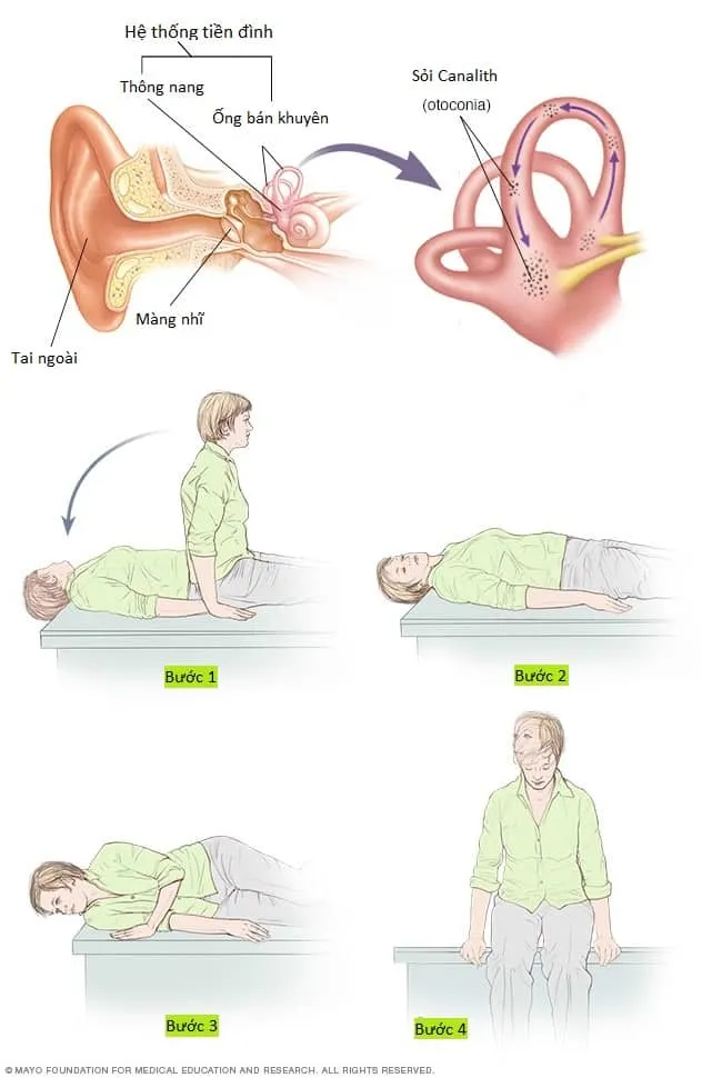 Tái định vị Canalith