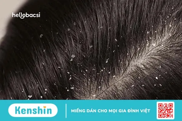 Tại sao gội đầu xong vẫn có gàu, vẫn bị ngứa?