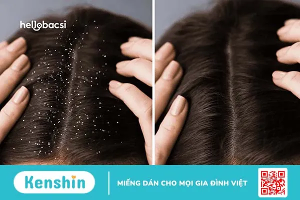 Tại sao gội đầu xong vẫn có gàu, vẫn bị ngứa?