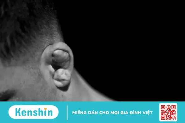 Tai súp lơ là gì? Nguyên nhân, triệu chứng, cách điều trị và phòng ngừa