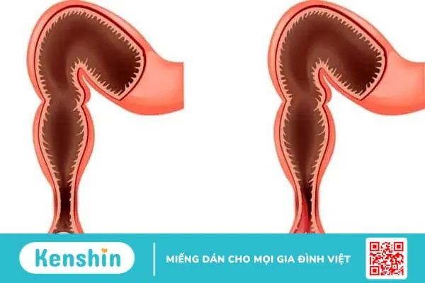 Táo bón lâu ngày có nguy hiểm không?