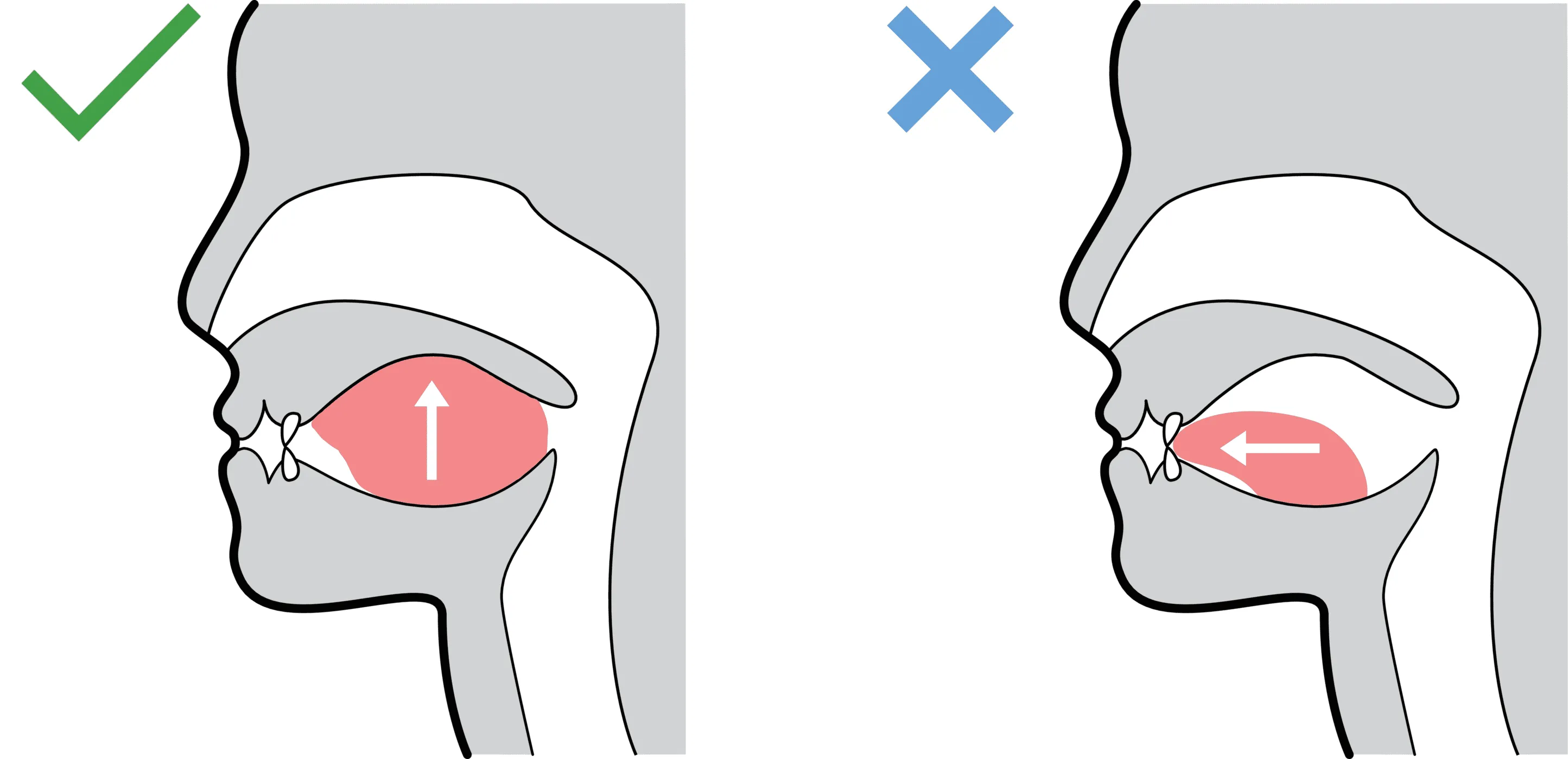 Tập há miệng sau khi nhổ răng khôn để không ảnh hưởng đến sinh hoạt