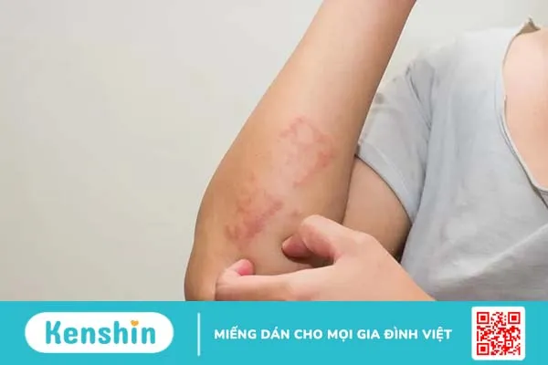 Tất cả những điều bạn cần biết xoay quanh bệnh viêm da dị ứng