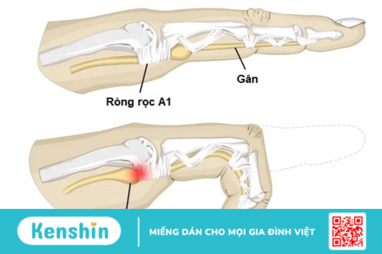 Tật ngón tay cò súng, đã có cách điều trị không phẫu thuật