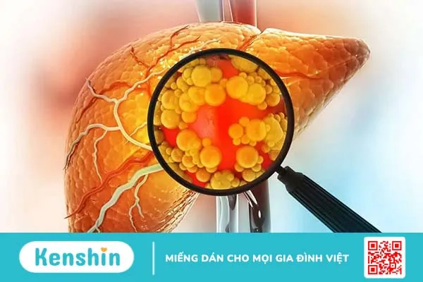 Tất tần tật thông tin cần biết về bệnh gan nhiễm mỡ