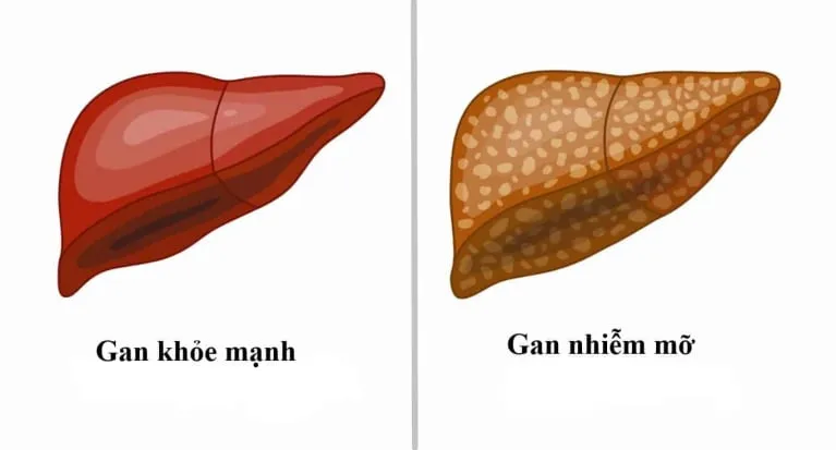 Tất tần tật thông tin cần biết về bệnh gan nhiễm mỡ