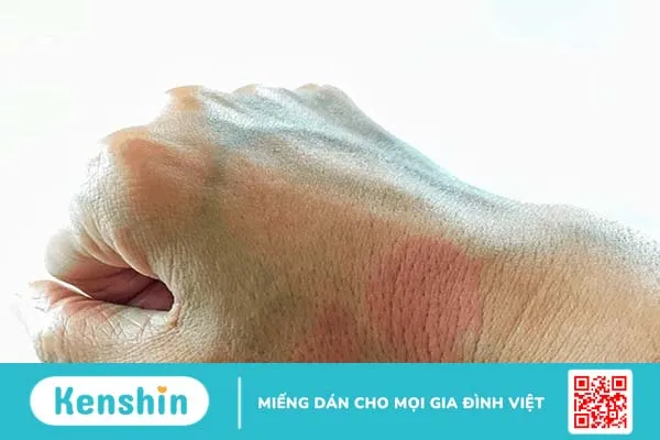 Tất tần tật thông tin về bệnh lupus ban đỏ dạng đĩa