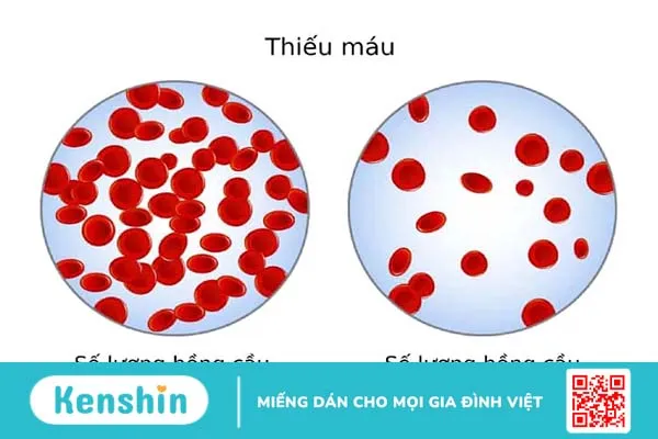 Tất tần tật thông tin về bệnh tan máu tự miễn