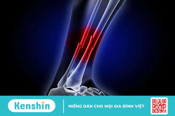Tất tần tật thông tin về gãy cẳng chân Tất tần tật thông tin về gãy cẳng chân
