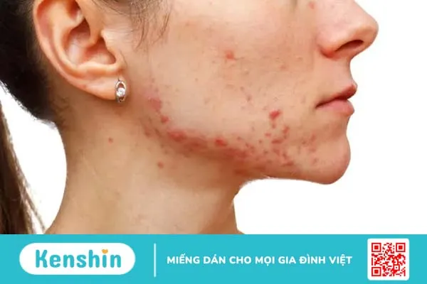 Tất tần tật về điều trị mụn trứng cá bạn cần biết