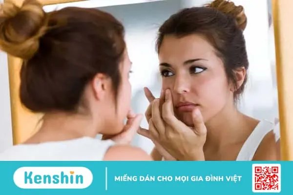 Tất tần tật về điều trị mụn trứng cá bạn cần biết