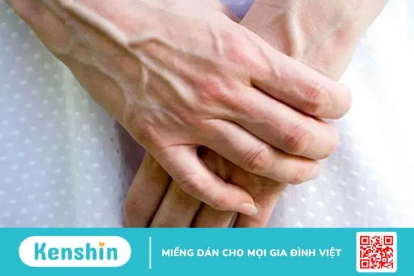 Tay chân nổi gân xanh là bệnh gì? Cách chữa hiệu quả