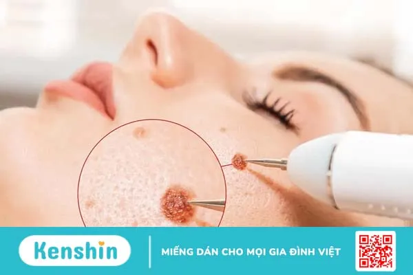 Tẩy nốt ruồi bao lâu thì bong vảy và cách chăm sóc để mau lành?