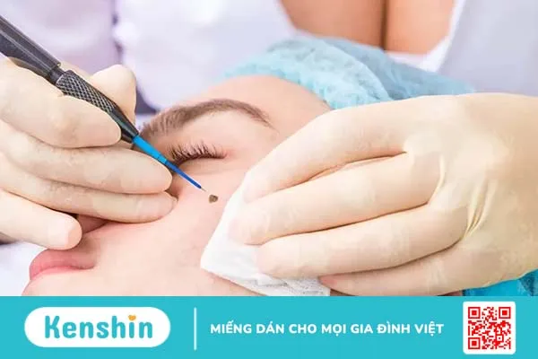 Tẩy nốt ruồi bao nhiêu tiền?