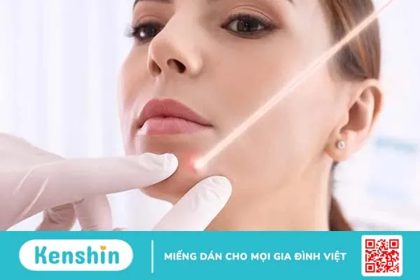 Tẩy nốt ruồi bao nhiêu tiền?