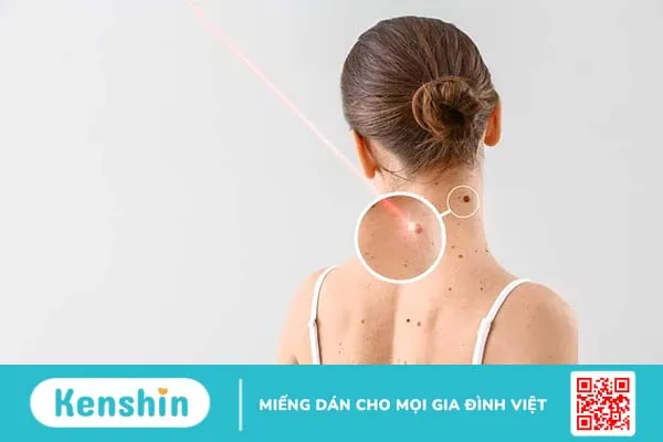 Tẩy nốt ruồi kiêng gì cho mau lành, hạn chế sẹo