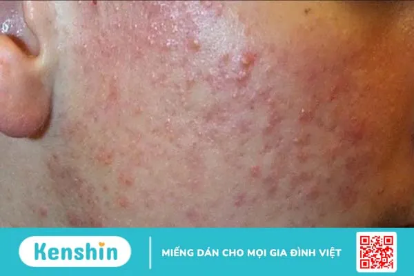 Thải độc da nhiễm corticoid tại nhà giúp da sáng khoẻ