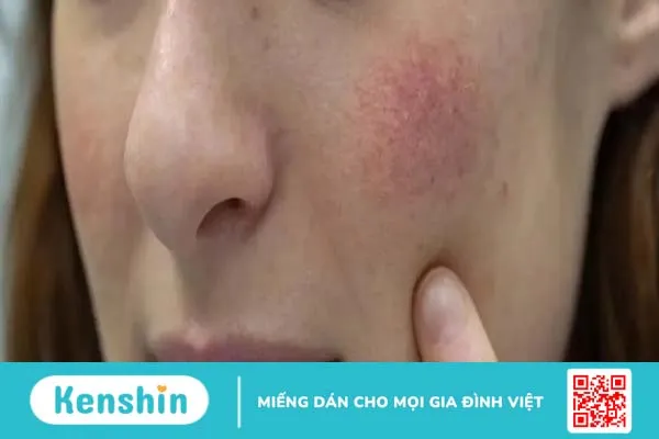 Thải độc da nhiễm corticoid tại nhà giúp da sáng khoẻ