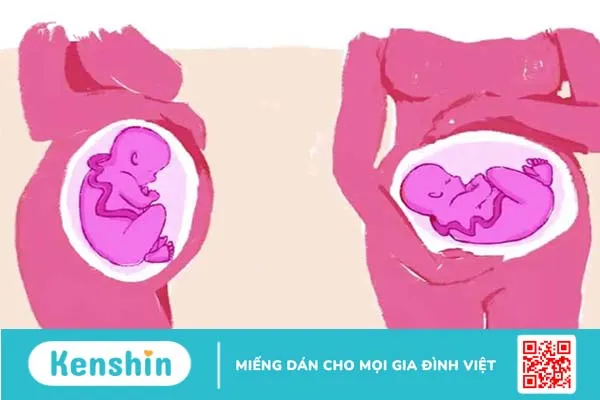 Thai ngôi ngang: Mẹ nên làm gì để thai nhi xoay về ngôi thuận?