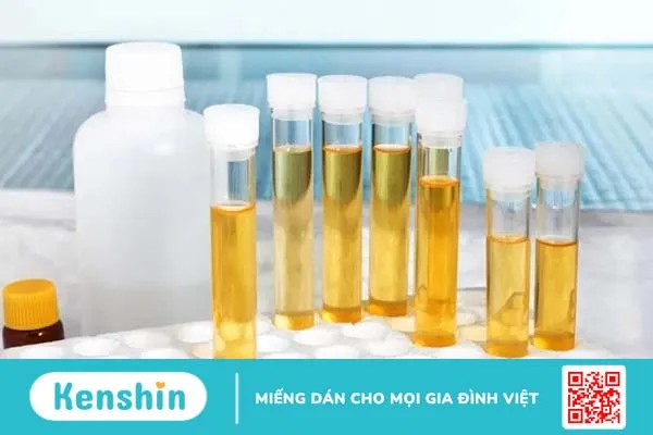 Thận nhiễm mỡ: Ai cũng có thể mắc bệnh