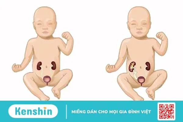 Thận ứ nước ở trẻ nhỏ: căn bệnh nguy hiểm mà cha mẹ cần lưu ý