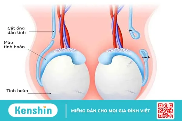 Thắt ống dẫn tinh có ảnh hưởng gì không?