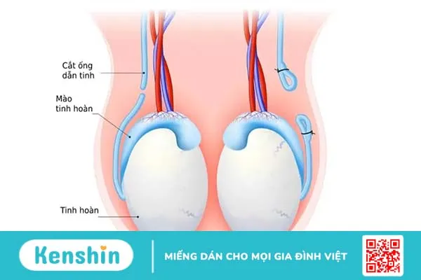 Thắt ống dẫn tinh thì tinh trùng đi đâu? Ảnh hưởng gì không?