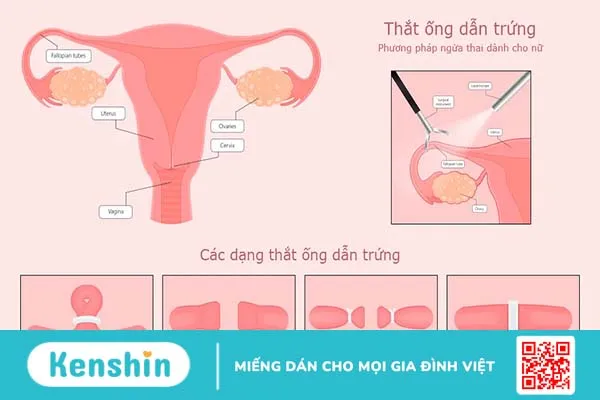 Thắt ống dẫn trứng bao lâu thì quan hệ được?