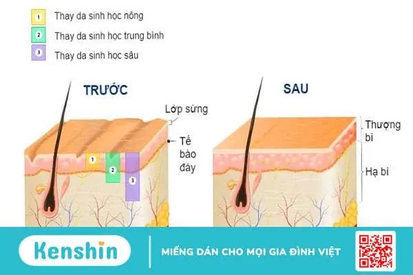 Thay da hóa học trị sẹo mụn: Những điều bạn cần biết