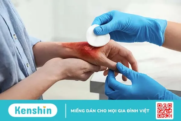 Thay da sinh học – phương pháp điều trị cho vết thương rộng