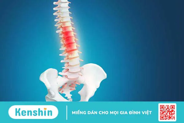 Thoát vị đĩa đệm L4 L5 và những điều cần phải biết về bệnh