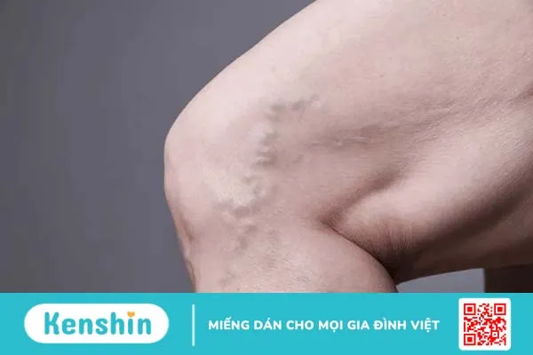 Thời điểm lý tưởng để mổ giãn tĩnh mạch thừng tinh