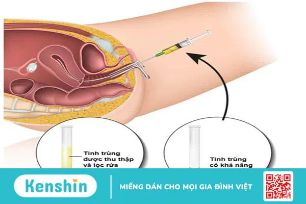 Thụ tinh nhân tạo: Những điều bạn cần biết để tăng cơ hội thụ thai