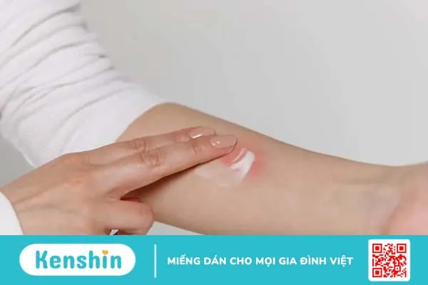 Thuốc bôi chống muỗi cho bà bầu có an toàn? Mẹ cần lưu ý điều gì?