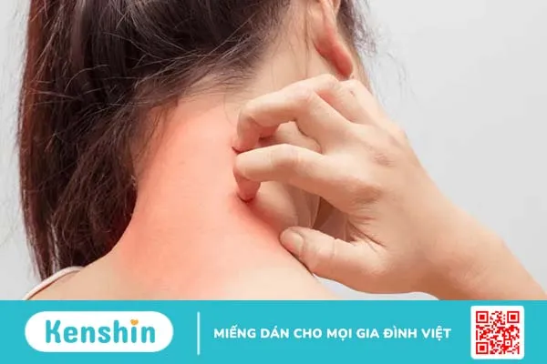 Thuốc trị viêm da cơ địa nào hiệu quả?