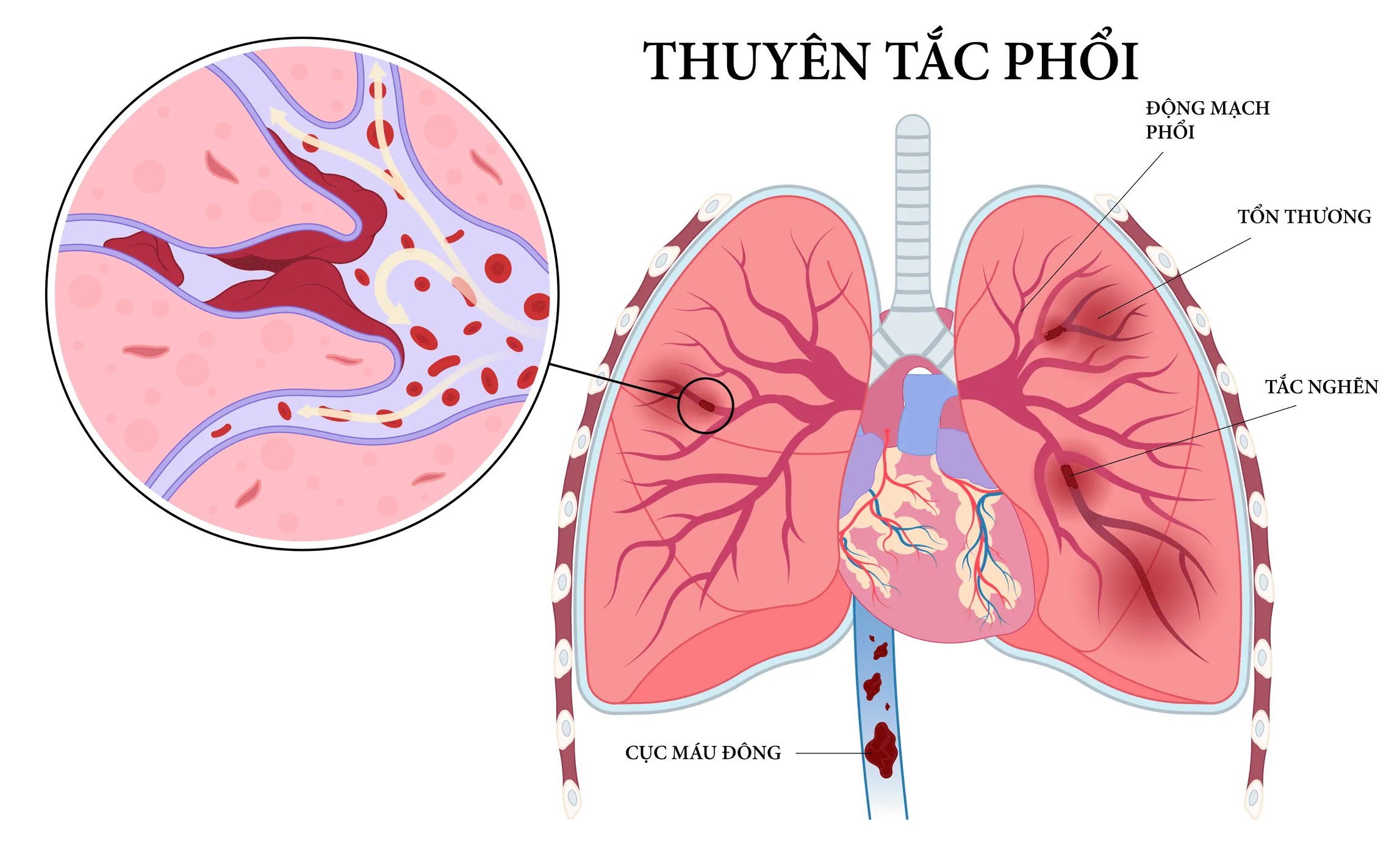 Thuyên tắc huyết khối tĩnh mạch trên bệnh nhân phẫu thuật tiêu hoá: Làm sao để có thể nhận biết nguy cơ và dự phòng hiệu quả?