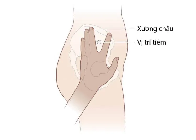 Tiêm bắp: Vị trí, quy trình và những lưu ý khi tiêm