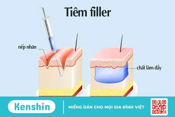 Tiêm filler – botox: Đâu là sự khác biệt