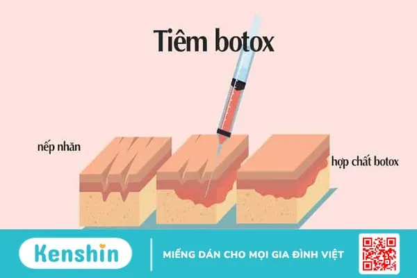 Tiêm filler – botox: Đâu là sự khác biệt