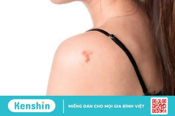 Tiêm sẹo lồi có an toàn và hiệu quả cho da?