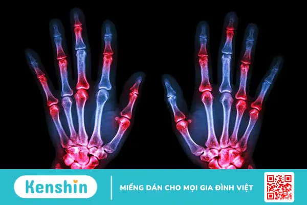 Tiêu chuẩn chẩn đoán viêm khớp dạng thấp và các xét nghiệm cần thiết