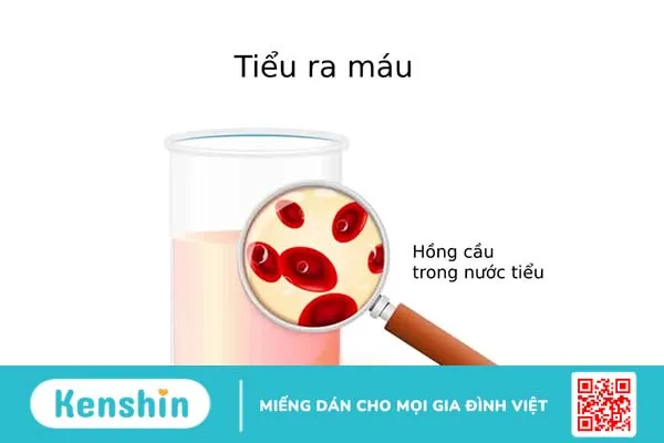 Tiểu ra máu