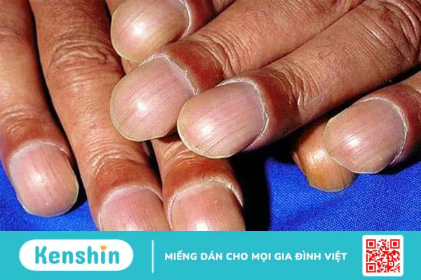 Tìm hiểu các cây thuốc chữa xơ phổi trong dân gian