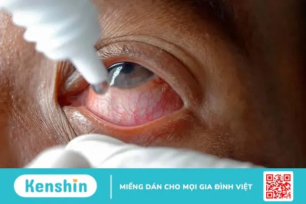 Tìm hiểu các loại thuốc nhỏ mắt trị viêm kết mạc